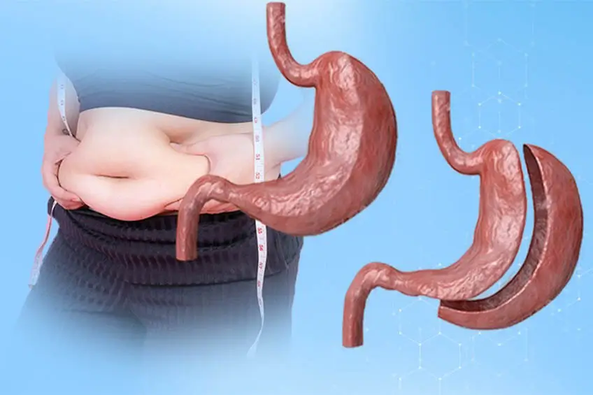 Tüp mide ameliyatı için ameliyathane ekibi