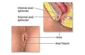ANAL FİSSÜR (MAKAT ÇATLAĞI)