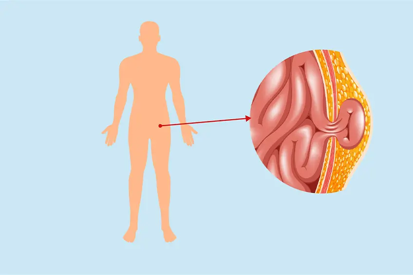 Kasık Fıtığı Nasıl Tedavi Edilir?