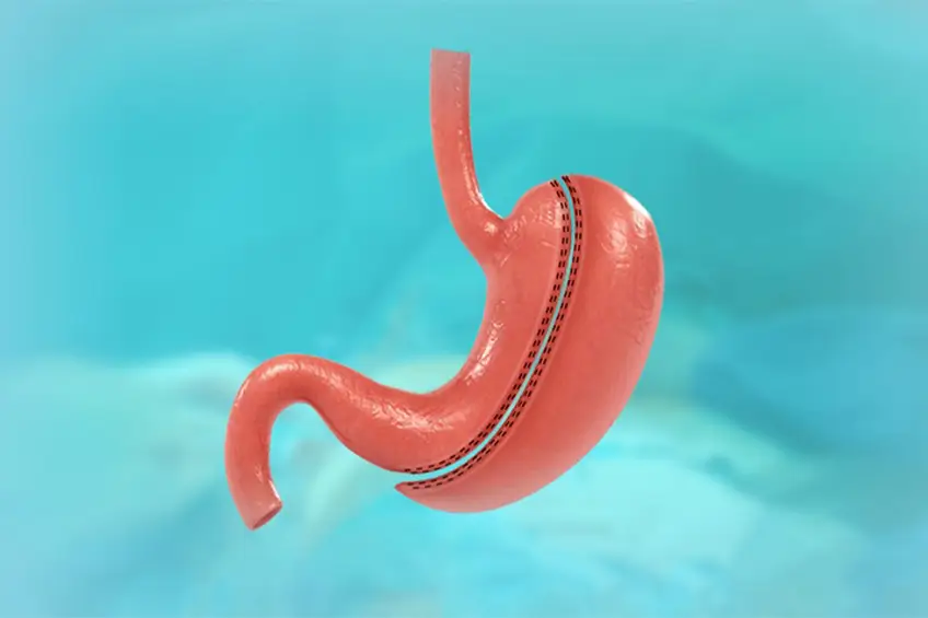 Tüp Mide Ameliyatı Tüp Mide Ameliyatı